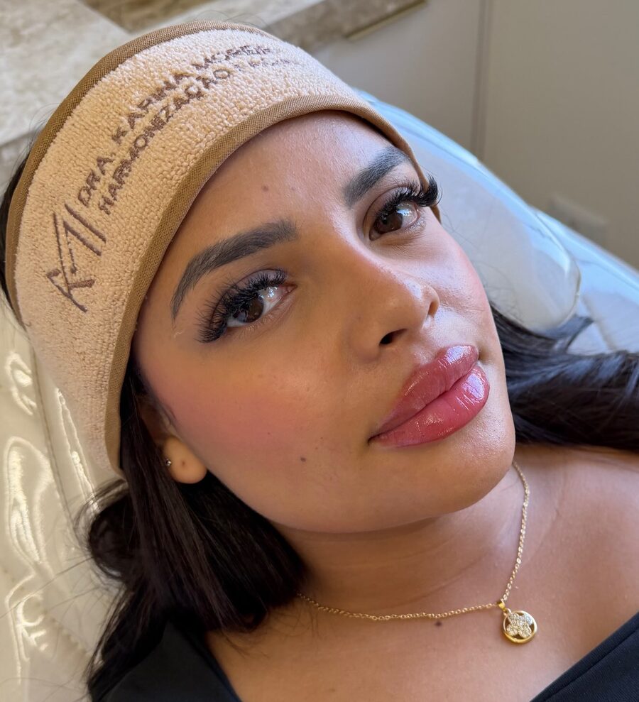 Paciente após preenchimento labial com a Dra. Karina Moreira